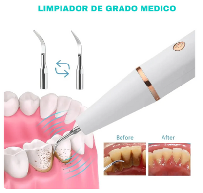 Removedor de Sarro Dental Magnético®